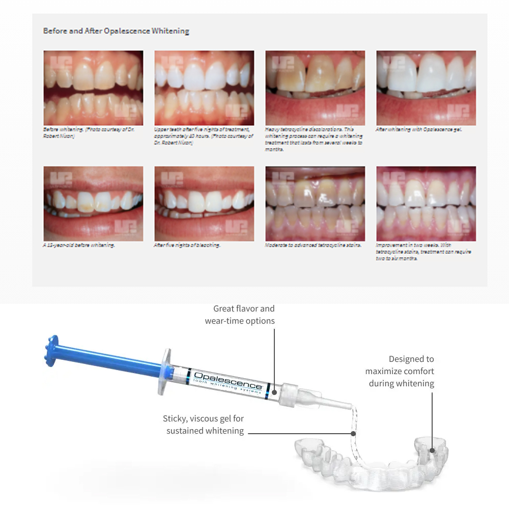 Opalescence Whitening 20% PF 2 - Teeth Whitening Bleaching Kit 评论和价格