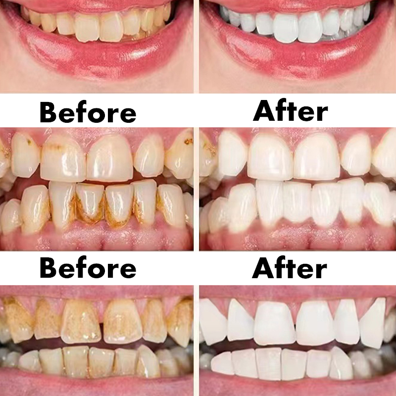 Teeth Whitening Pen Dental Ess - Teeth Whitening Bleaching Kit 评论和价格